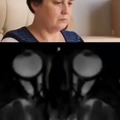 MRI vids of people rubbing their eyes as demonstrated
